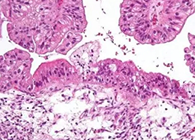 【Science速遞】“沉默的殺手”卵巢癌的治療新靶點終于被發(fā)現(xiàn)了