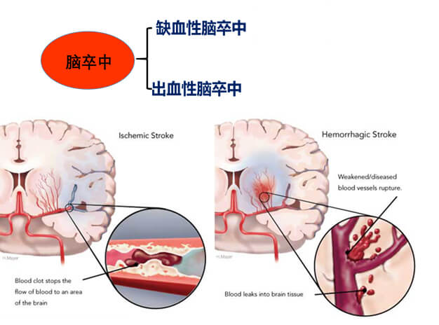1-腦中風(fēng)主要有缺血性中風(fēng)和出血性腦卒中.jpg