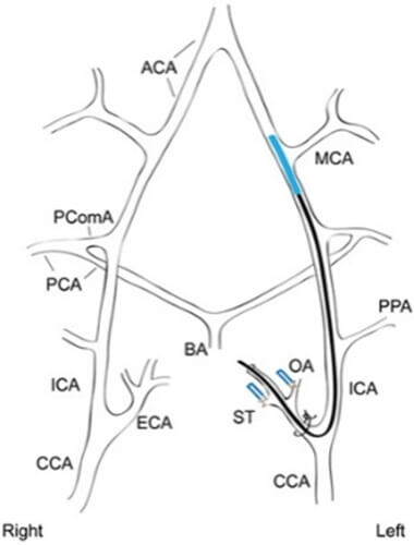 2-在試驗(yàn)中通常使用經(jīng)典的線栓法建立模型.jpg