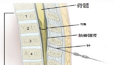 經(jīng)腰椎穿刺采集腦脊液.jpg